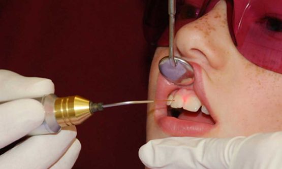 Ein Patient wird mit der Laserakupunktur behandelt - Zahnarztpraxis Dr. Thomas Dietrich 